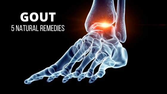 5 Natural Remedies for Gout